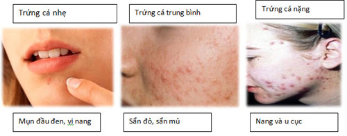 Có phải mụn trứng cá do nóng gan gây nên?