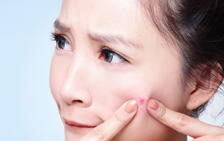 Có phải mụn trứng cá do nóng gan gây nên?