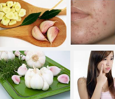 Cách trị mụn trứng cá hiệu quả nhanh nhất tại nhà năm 2016
