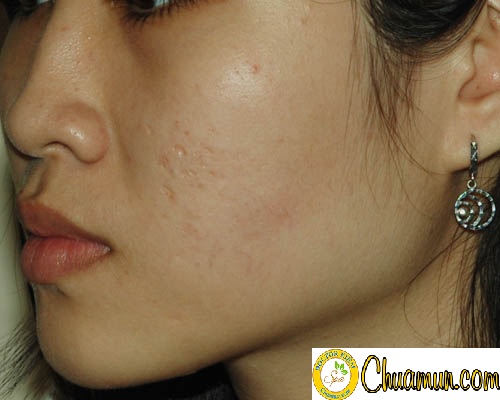 Cho em hỏi sẹo mụn có điều trị dứt điểm được không? Cho em hỏi sẹo mụn có điều trị dứt điểm được không?
