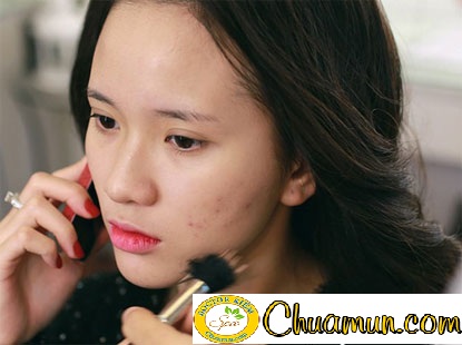 5 điều tối kỵ khi điều trị mụn bạn cần phải biết 5 điều tối kỵ khi điều trị mụn bạn cần phải biết