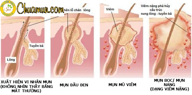 Giải pháp trị mụn trứng cá bọc hiệu quả bạn nên biết Giải pháp trị mụn trứng cá bọc hiệu quả bạn nên biết