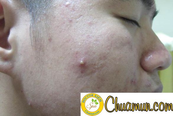 Cách điều trị mụn trứng cá siêu đơn giản tại nhà Cách điều trị mụn trứng cá siêu đơn giản tại nhà