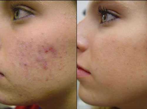 cach trị mụn trứng ca va vet tham nhanh