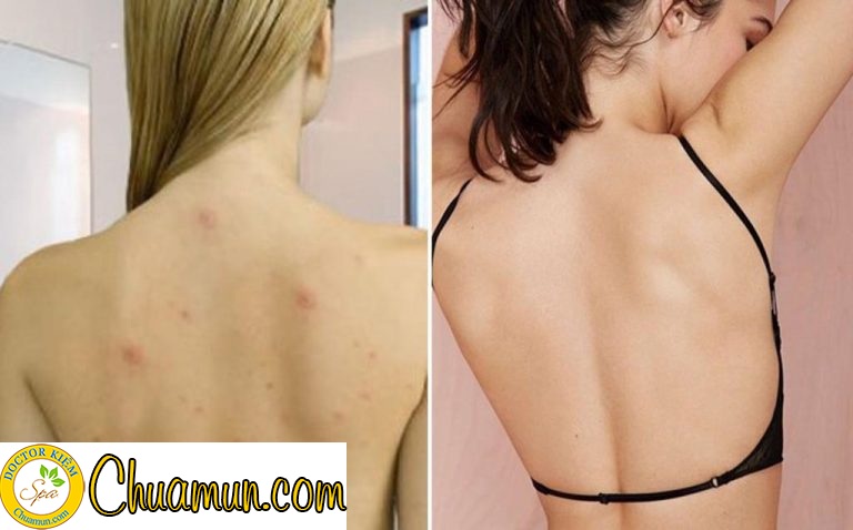 Làm sao để hết mụn và vết thâm ở lưng? Làm sao để hết mụn và vết thâm ở lưng?