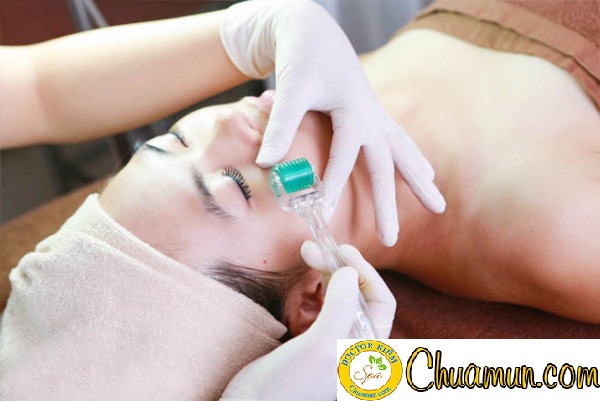 Lăn kim trị sẹo có thực sự đem lại hiệu quả?